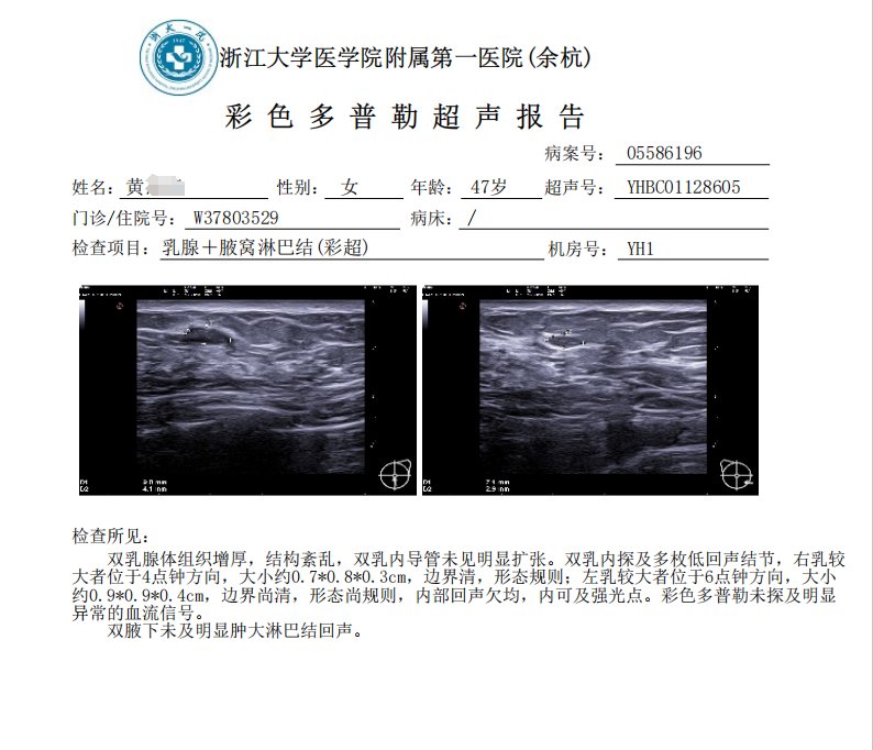 乳腺超声复查报告——结节缩小降级