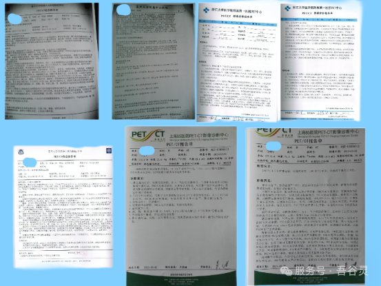 非霍奇金淋巴瘤PET/CT复查报告——淋巴结FDG代谢正常