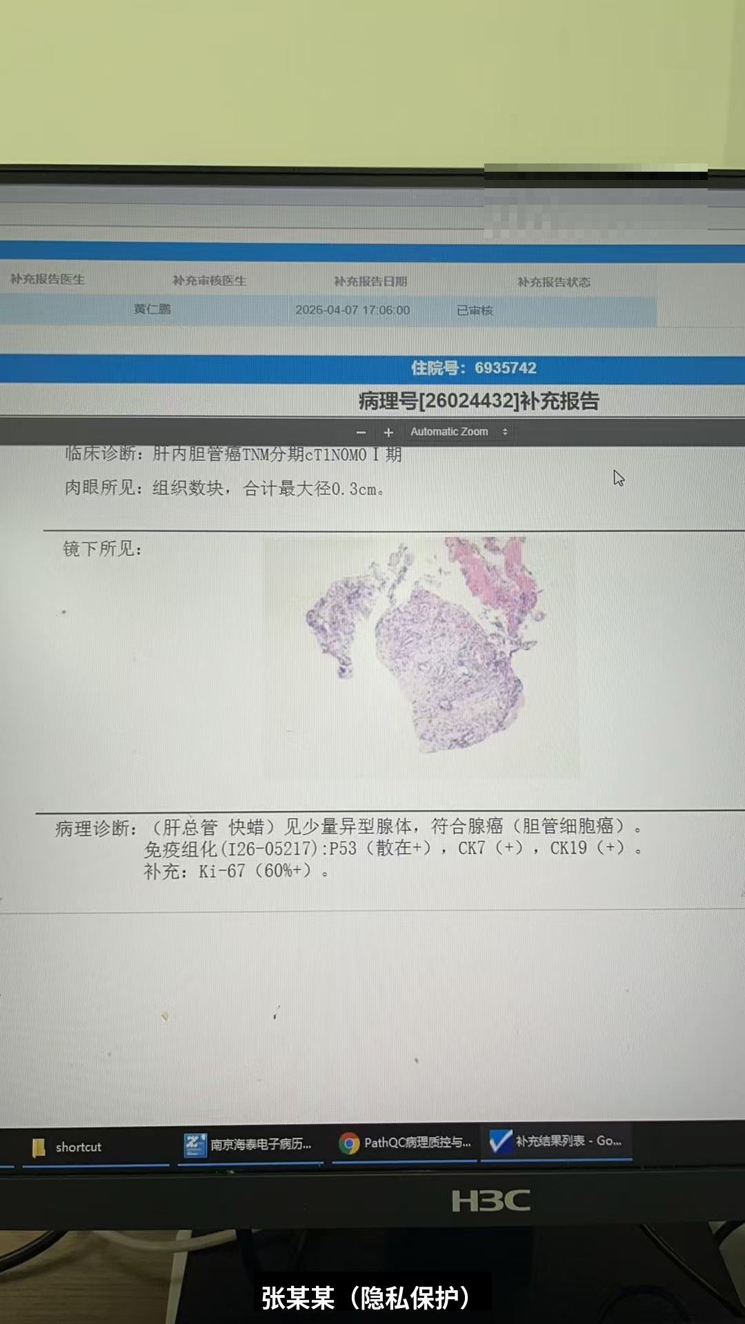 肝内胆管细胞癌cT1N0M0 IA期病理确诊报告-胆管细胞癌-2026-04-07